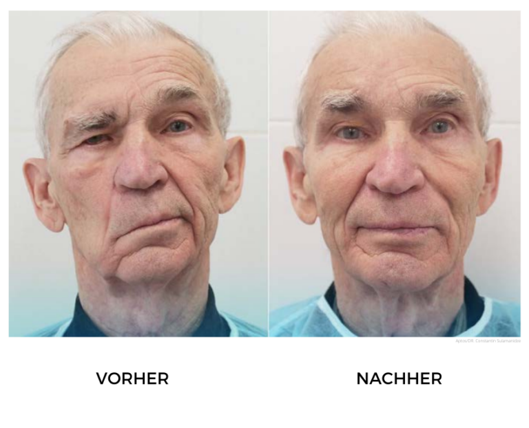 Fadenlifting behandlung durchgeführt von erfahrenen Arzt Facelifting HH