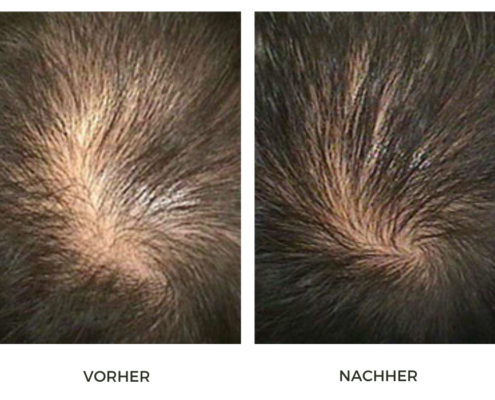 Hair Filler treatment - Clinic MF