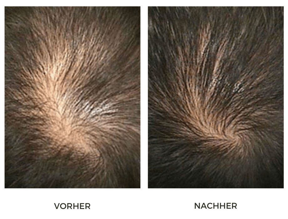  Hair Filler - PRP for Hair Loss | Costs & Procedure, Hamburg